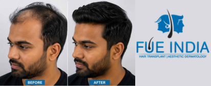 hair transplant cost